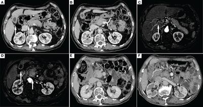 Xanthogranulomatous inflammation involving the gallbladder, bile duct, and pancreas: a case report